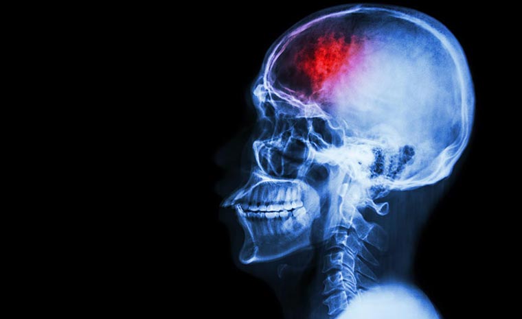 hematomas intracranianos e avaliacao da qualidade de vida apos o tratamento perspectivas dos pacientes