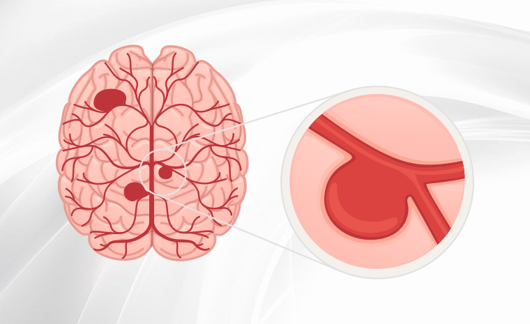 o que a pessoa sente ao ter um aneurisma cerebral
