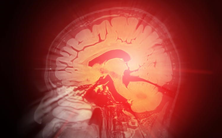 por que alguns aneurismas crescem e outros permanecem estaveis