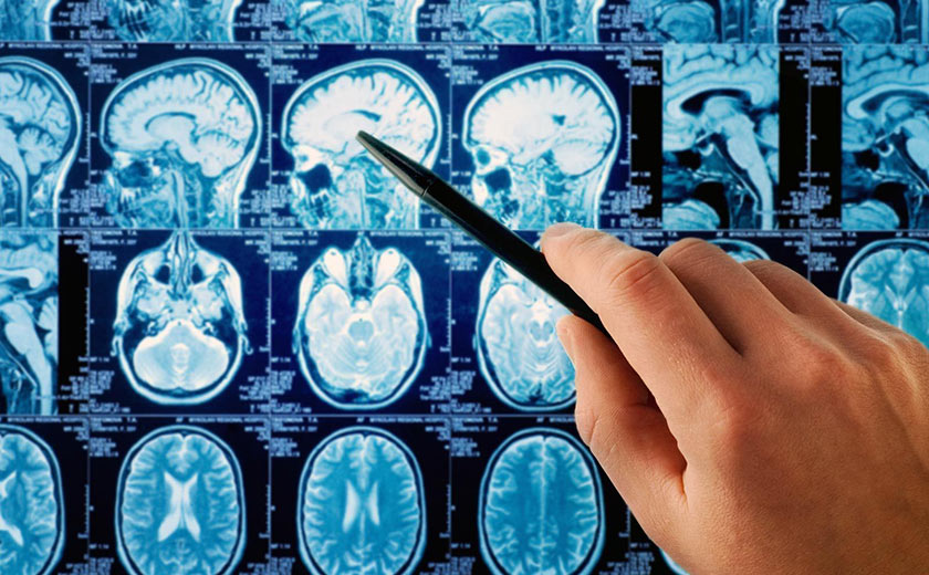 tumor intracraniano tumor cerebral