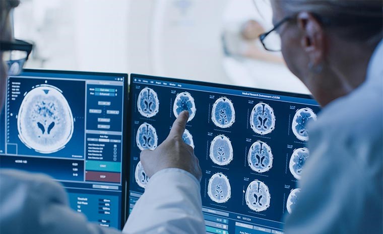 tumores cerebrais benignos e circulacao sanguinea quando o risco vascular pede atencao